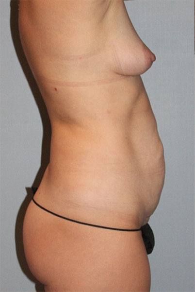 Patient Tummy Tuck Before 2