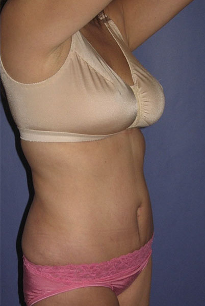 Patient Tummy Tuck Before 1