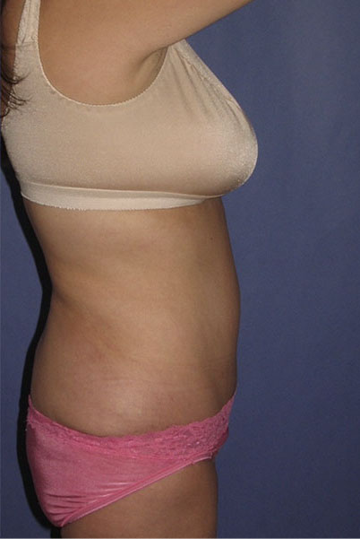 Patient Tummy Tuck Before 2