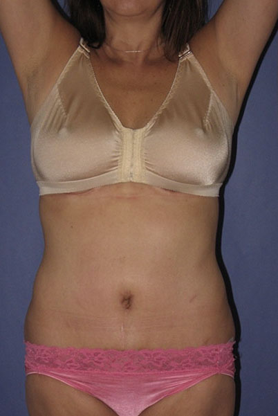 Patient Tummy Tuck Before 0