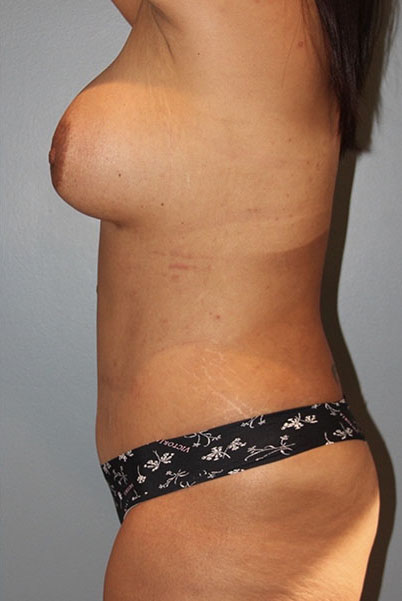 Patient Tummy Tuck Before 2