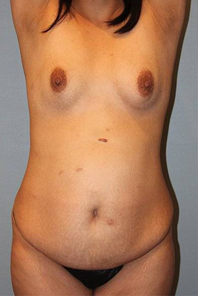 Patient Tummy Tuck Before 0