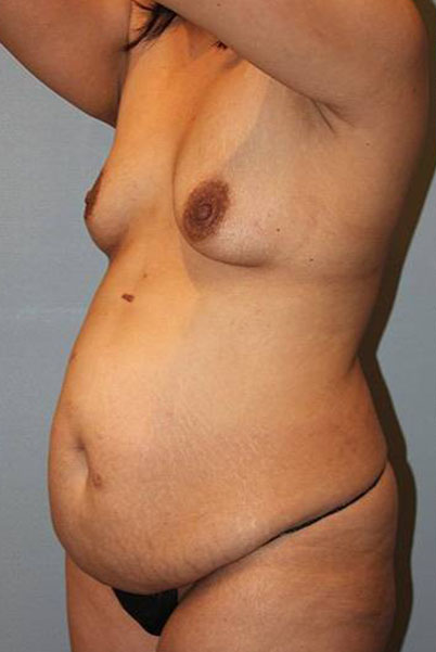 Patient Tummy Tuck Before 1