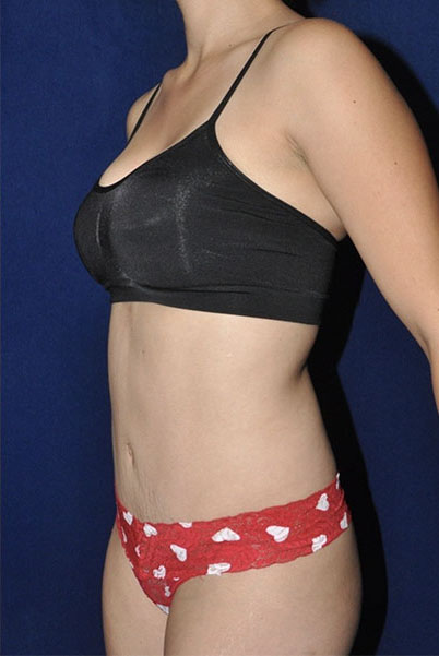 Patient Tummy Tuck Before 1