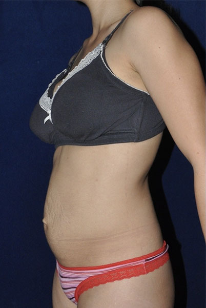 Patient Tummy Tuck Before 1