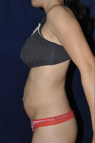 Patient Tummy Tuck Before 2