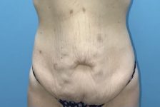 Patient Tummy Tuck Thumbnail Before 0