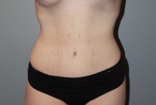 Patient Tummy Tuck Thumbnail After 0