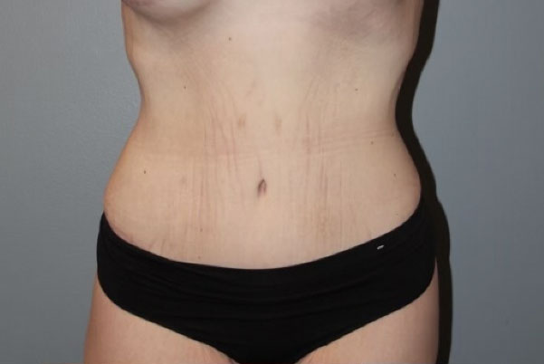 Patient Tummy Tuck Before 0