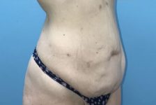 Patient Tummy Tuck Thumbnail Before 1