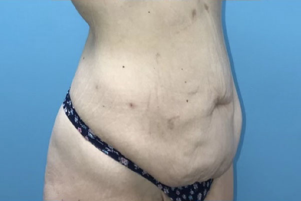 Patient Tummy Tuck Before 1