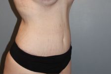 Patient Tummy Tuck Thumbnail After 1
