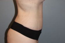 Patient Tummy Tuck Thumbnail After 2