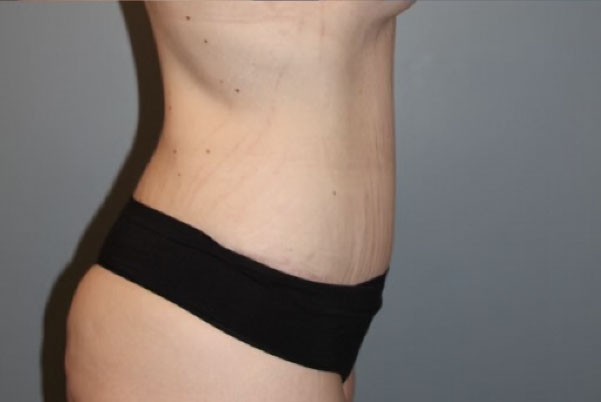 Patient Tummy Tuck Before 2