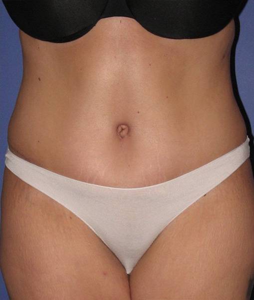 after tummy tuck front view of female patient 486 at Paydar Plastic Surgery