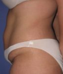 before tummy tuck left side view of female patient 486 at Paydar Plastic Surgery