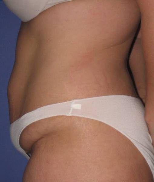 before tummy tuck left side view of female patient 486 at Paydar Plastic Surgery