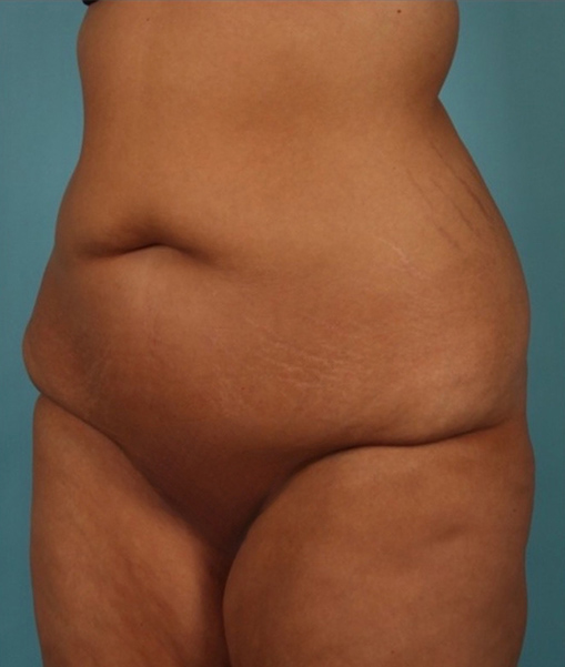 Patient Tummy Tuck Before 1