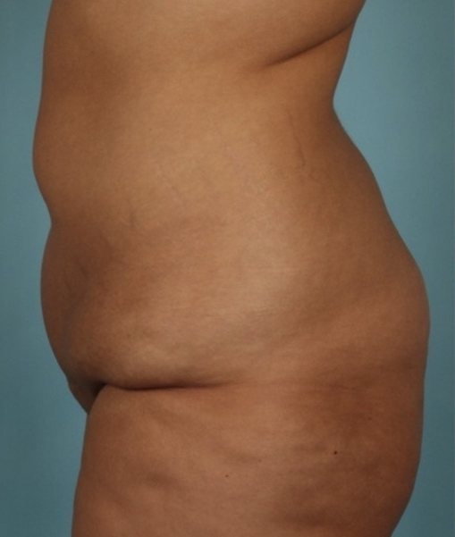 Patient Tummy Tuck Before 2