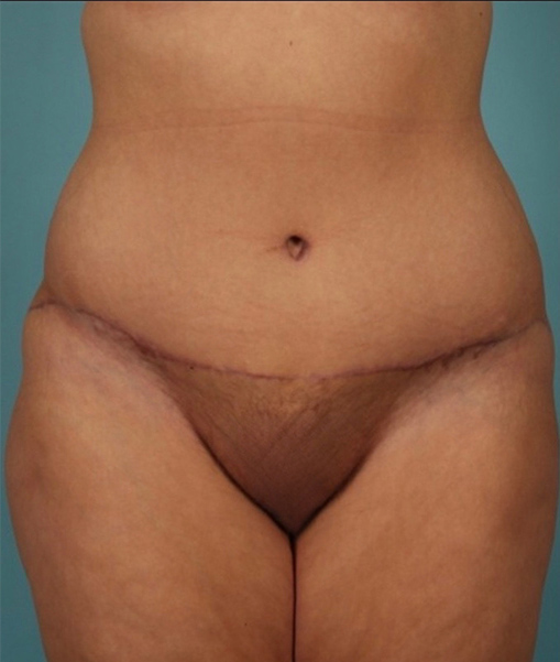 Patient Tummy Tuck Before 0