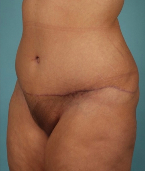 Patient Tummy Tuck Before 1