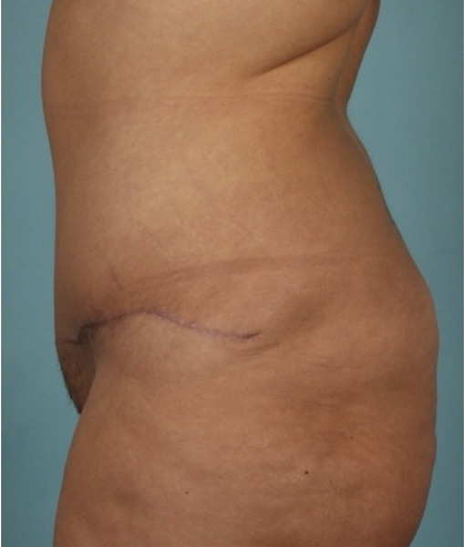 Patient Tummy Tuck Before 2