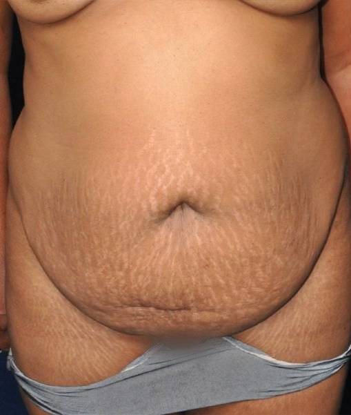 before tummy tuck front view of female patient 529 at Paydar Plastic Surgery