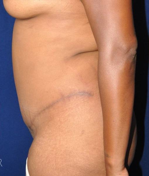 after tummy tuck left side view of female patient 529 at Paydar Plastic Surgery