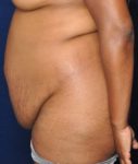 before tummy tuck left side view of female patient 529 at Paydar Plastic Surgery