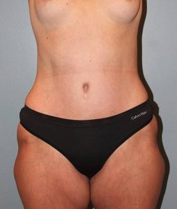 Patient Tummy Tuck After 0