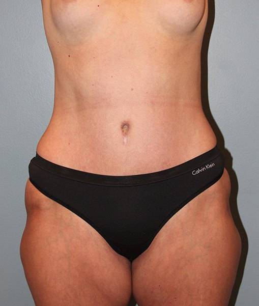 after tummy tuck front view female patient case 755