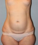 before tummy tuck front view female patient case 755