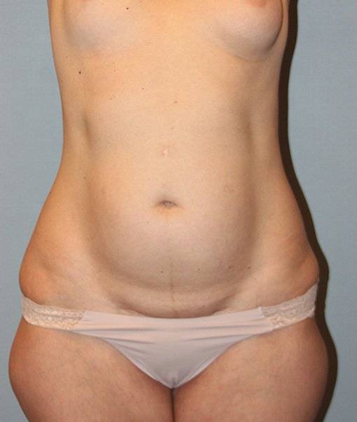 before tummy tuck front view female patient case 755