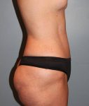 after tummy tuck side view female patient case 755