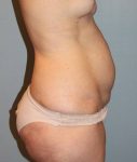 before tummy tuck side view female patient case 755