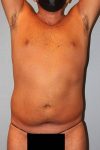 before tummy tuck front view male patient case 864