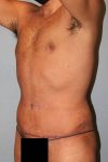 after tummy tuck angle view male patient case 864