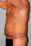 before tummy tuck angle view male patient case 864