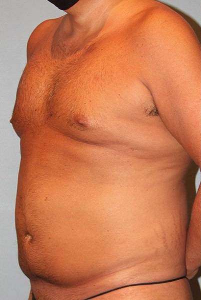 before tummy tuck angle view male patient case 864