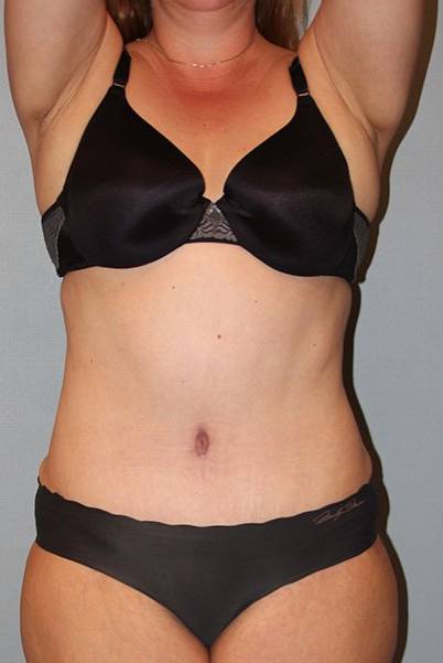 after tummy tuck front view female patient case 910