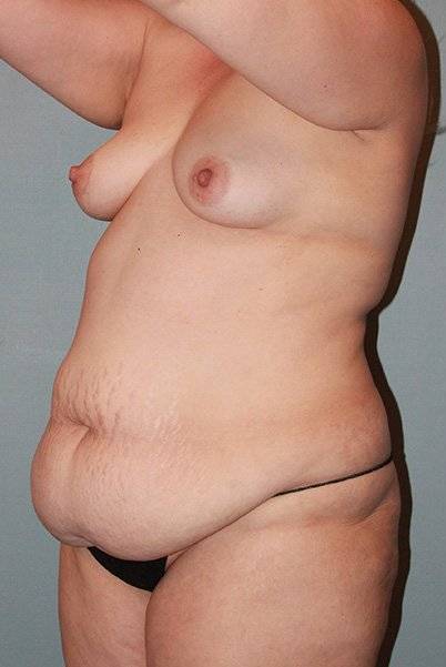 before tummy tuck angle view female patient case 910