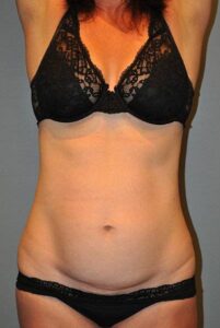 before tummy tuck front view female patient case 921