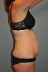 before tummy tuck side view female patient case 921