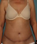 after abdominoplasty front view of female patient 413 at Paydar Plastic Surgery