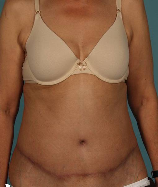 after abdominoplasty front view of female patient 413 at Paydar Plastic Surgery