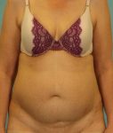 before abdominoplasty front view of female patient 413 at Paydar Plastic Surgery