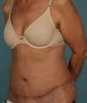after abdominoplasty left angle view of female patient 413 at Paydar Plastic Surgery