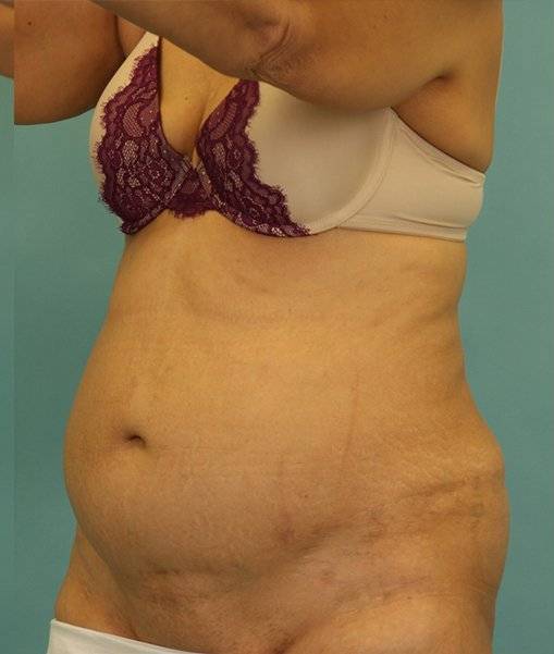 before abdominoplasty left angle view of female patient 413 at Paydar Plastic Surgery