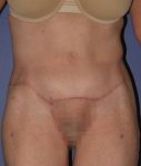 after abdominoplasty front view of female patient 436 at Paydar Plastic Surgery