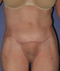 after abdominoplasty front view of female patient 436 at Paydar Plastic Surgery